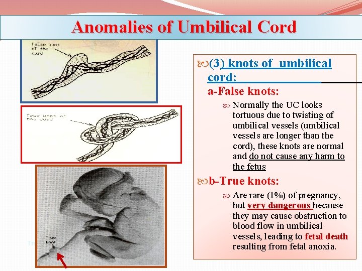 Anomalies of Umbilical Cord (3) knots of umbilical cord: a-False knots: Normally the UC