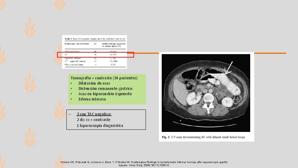 Tomografía + contraste (34 pacientes) • Dilatación de asas • Distensión remanente gástrico •