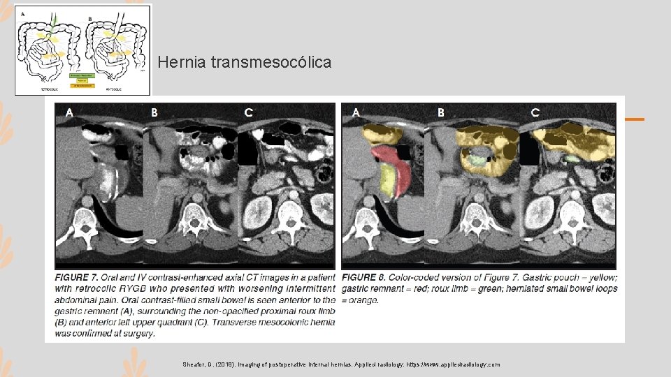 Hernia transmesocólica Sheafor, D. (2018). Imaging of postoperative internal hernias. Applied radiology. https: //www.