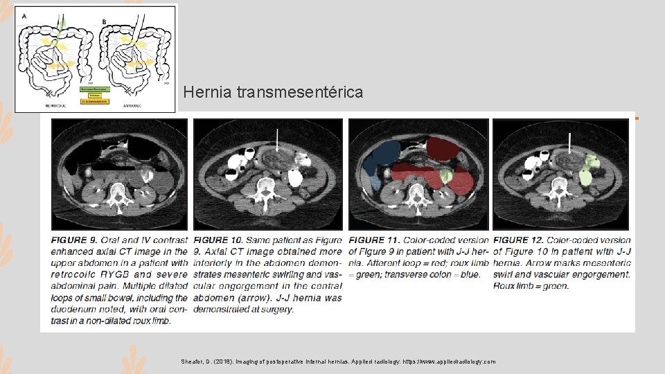 Hernia transmesentérica Sheafor, D. (2018). Imaging of postoperative internal hernias. Applied radiology. https: //www.
