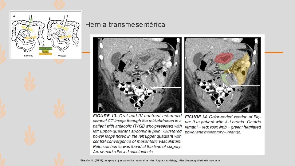 Hernia transmesentérica Sheafor, D. (2018). Imaging of postoperative internal hernias. Applied radiology. https: //www.