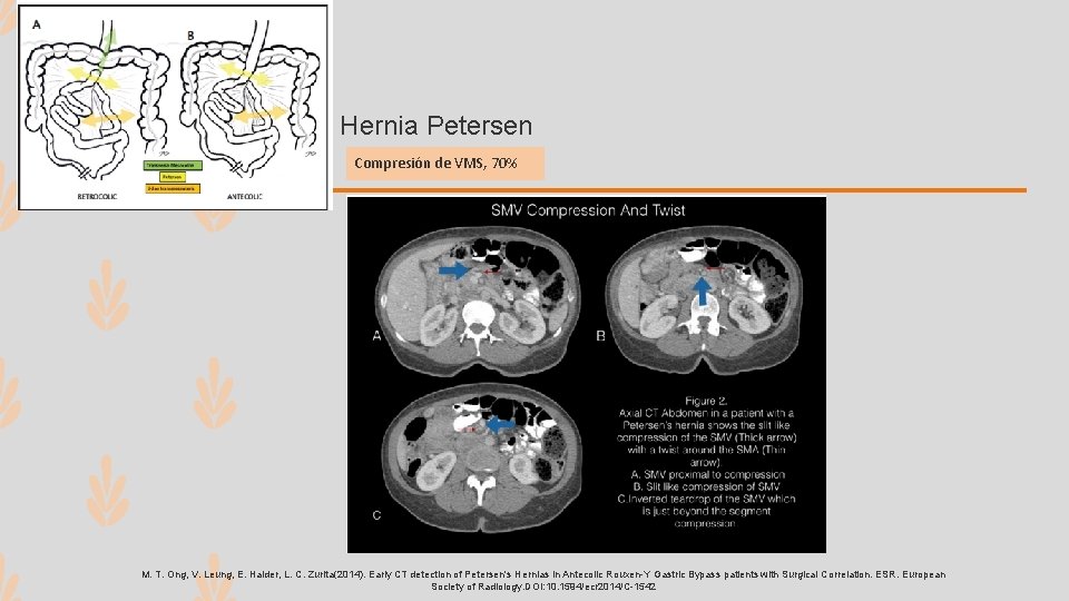 Hernia Petersen Compresión de VMS, 70% M. T. Ong, V. Leung, E. Haider, L.