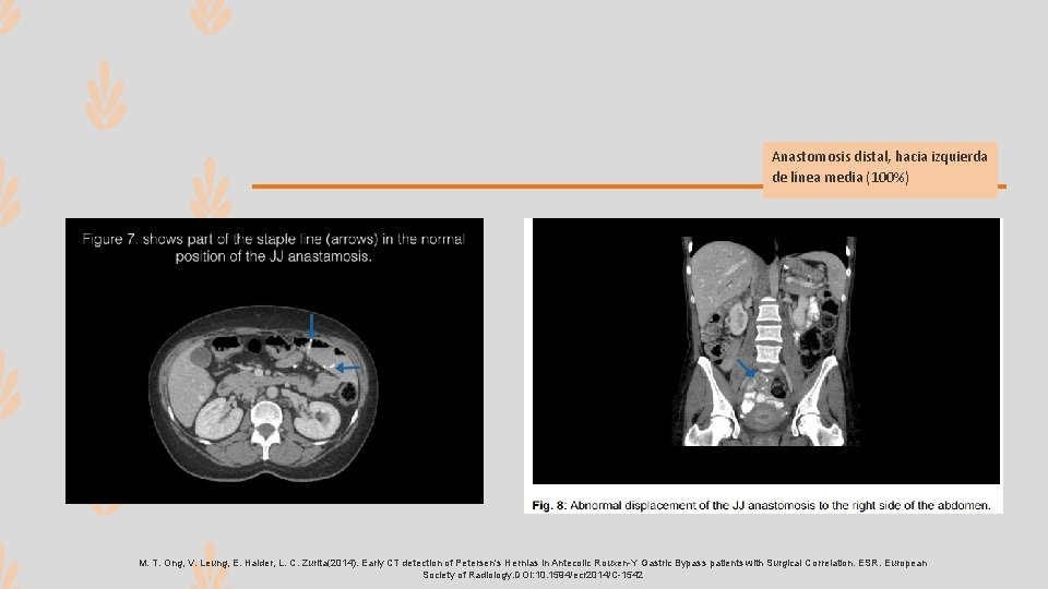 Anastomosis distal, hacia izquierda de línea media (100%) M. T. Ong, V. Leung, E.