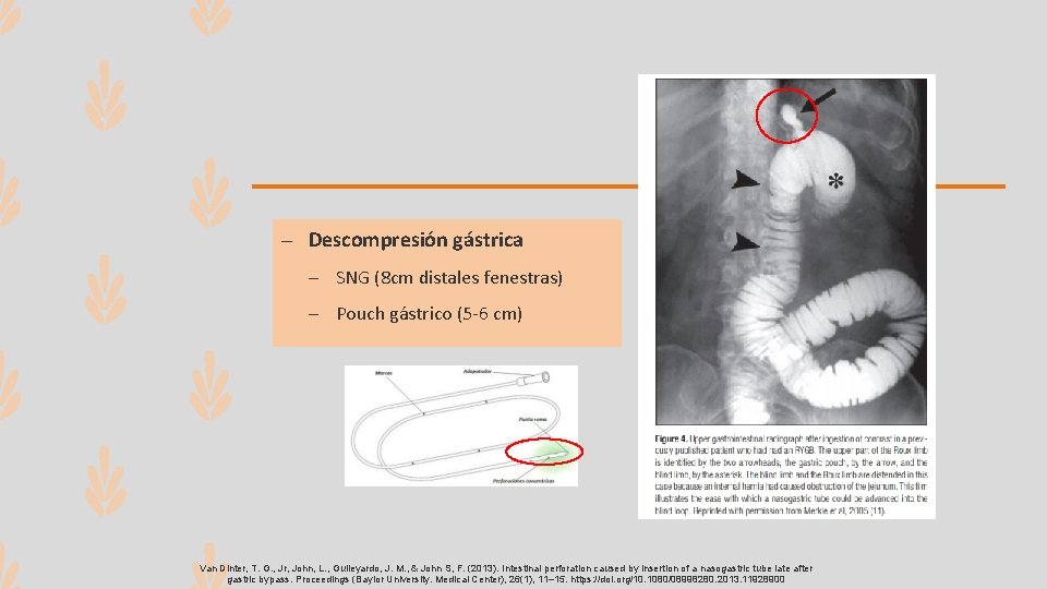 – Descompresión gástrica – SNG (8 cm distales fenestras) – Pouch gástrico (5 -6