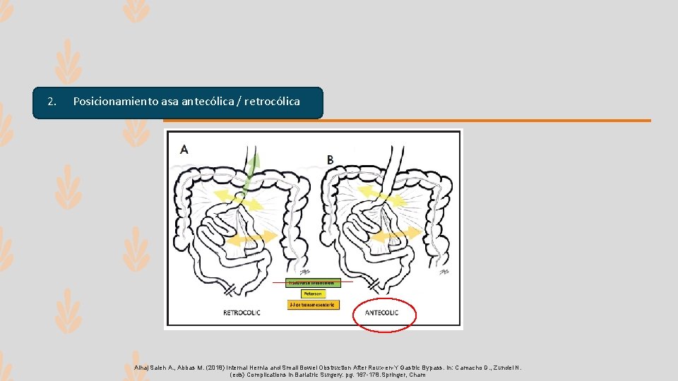 2. Posicionamiento asa antecólica / retrocólica Alhaj Saleh A. , Abbas M. (2018) Internal