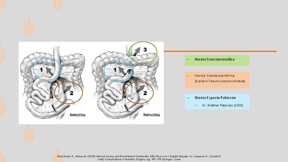 – Hernia transmesocólica – Hernia transmesentérica (espacio Yeyuno-yeyunostomía) – Hernia Espacio Petersen – Dr.
