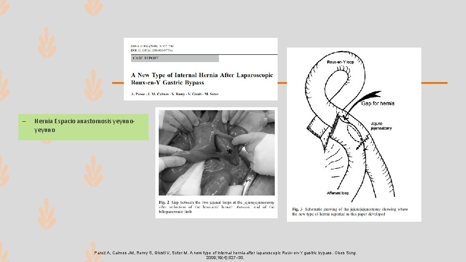 – Hernia Espacio anastomosis yeyuno Paroz A, Calmes JM, Romy S, Giusti V, Suter