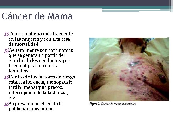 Cáncer de Mama Tumor maligno más frecuente en las mujeres y con alta tasa