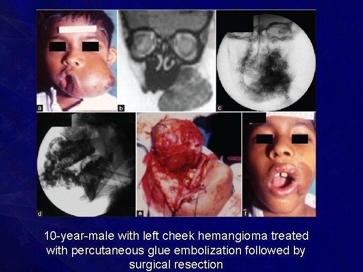 10 -year-male with left cheek hemangioma treated with percutaneous glue embolization followed by surgical