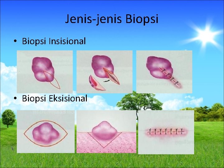 Jenis-jenis Biopsi • Biopsi Insisional • Biopsi Eksisional 