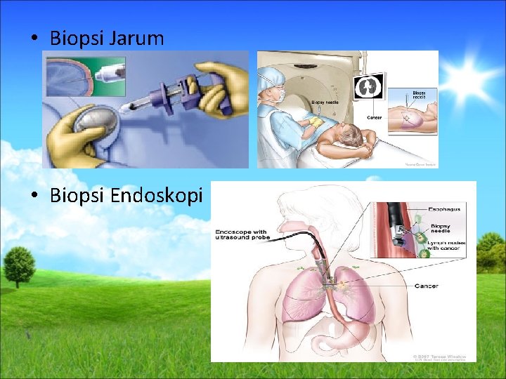  • Biopsi Jarum • Biopsi Endoskopi 
