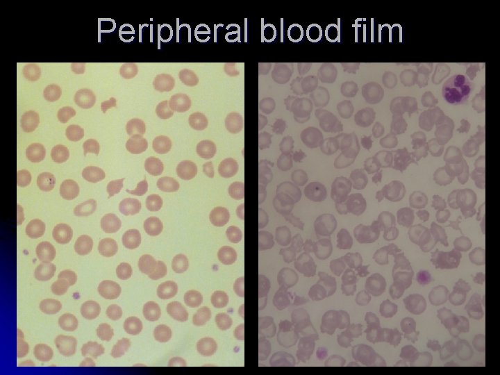 Peripheral blood film 