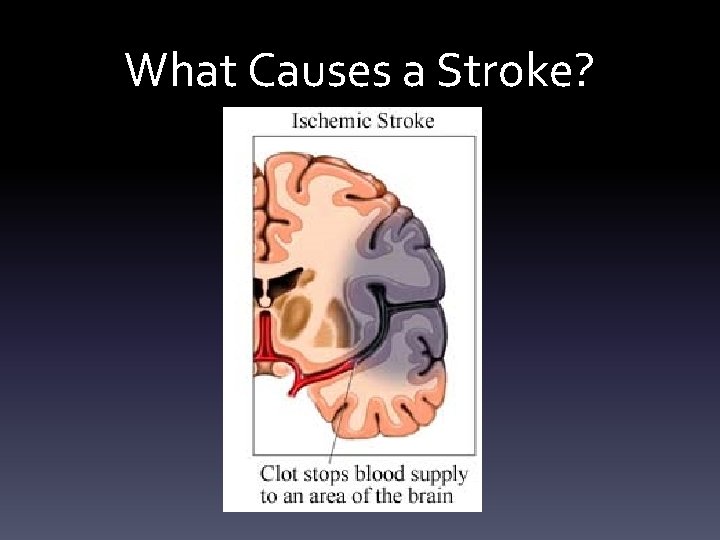 What Causes a Stroke? 