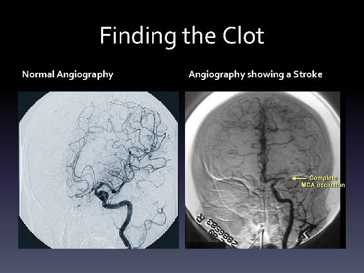 Finding the Clot Normal Angiography showing a Stroke 