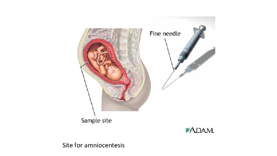 Site for amniocentesis 