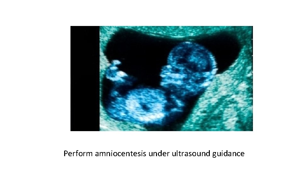 Perform amniocentesis under ultrasound guidance 