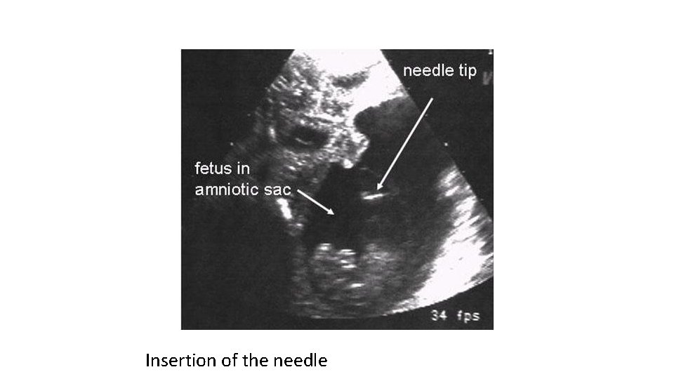 Insertion of the needle 