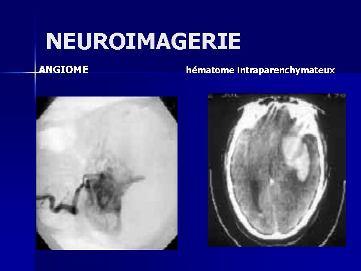 NEUROIMAGERIE ANGIOME hématome intraparenchymateux 