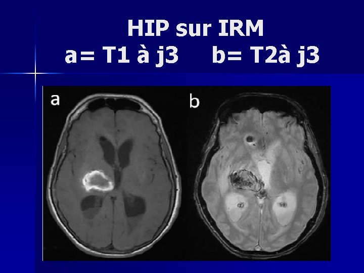  HIP sur IRM a= T 1 à j 3 b= T 2à j