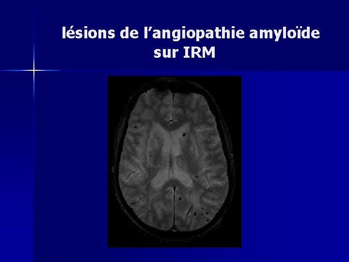  lésions de l’angiopathie amyloïde sur IRM 