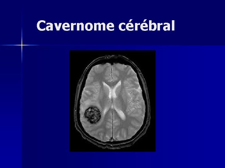  Cavernome cérébral 