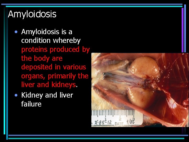 Amyloidosis • Amyloidosis is a condition whereby proteins produced by the body are deposited