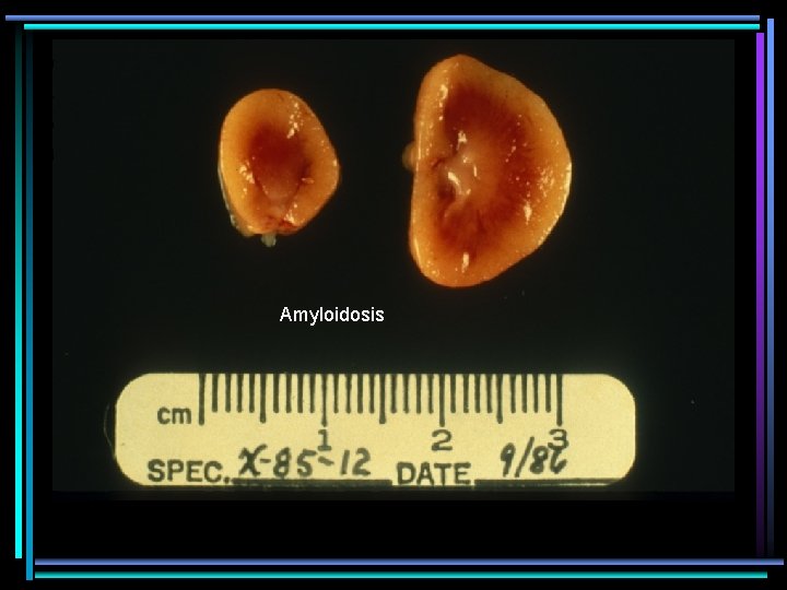 Amyloidosis 