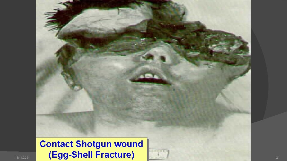 3/11/2021 Contact Shotgun wound (Egg-Shell Fracture) 21 