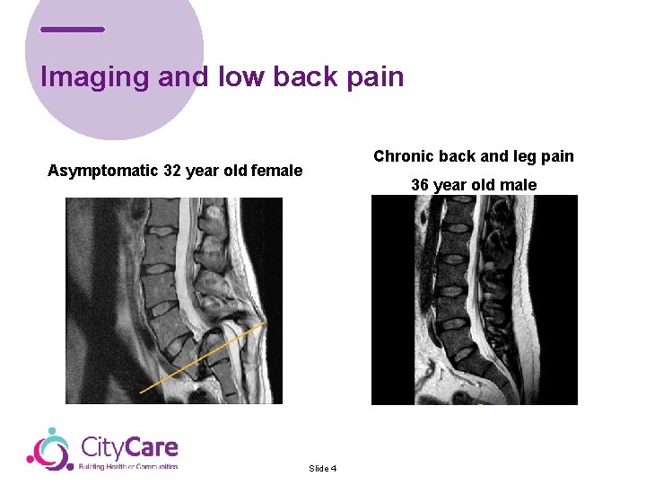 Imaging and low back pain Chronic back and leg pain Asymptomatic 32 year old