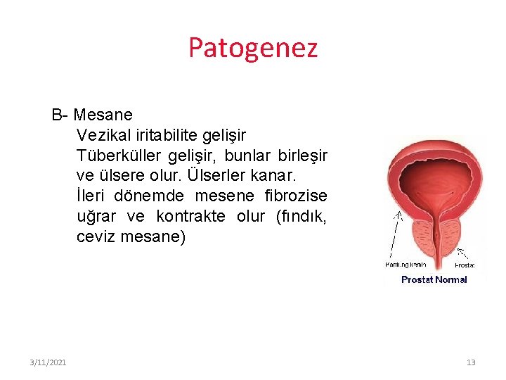 Patogenez B- Mesane Vezikal iritabilite gelişir Tüberküller gelişir, bunlar birleşir ve ülsere olur. Ülserler