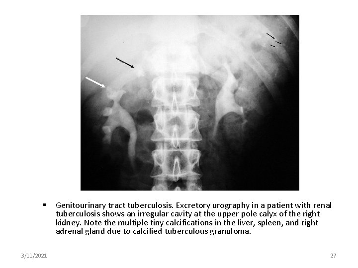  3/11/2021 Genitourinary tract tuberculosis. Excretory urography in a patient with renal tuberculosis shows