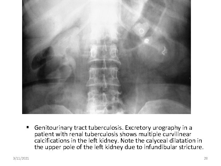  Genitourinary tract tuberculosis. Excretory urography in a patient with renal tuberculosis shows multiple
