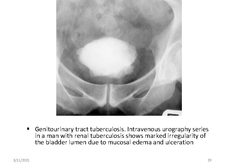  Genitourinary tract tuberculosis. Intravenous urography series in a man with renal tuberculosis shows