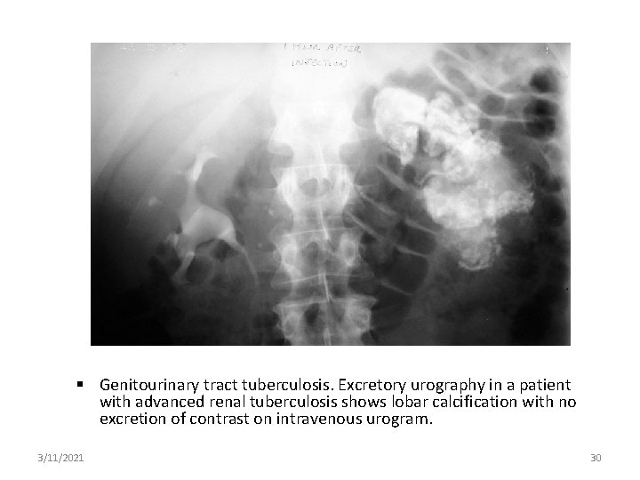 Genitourinary tract tuberculosis. Excretory urography in a patient with advanced renal tuberculosis shows