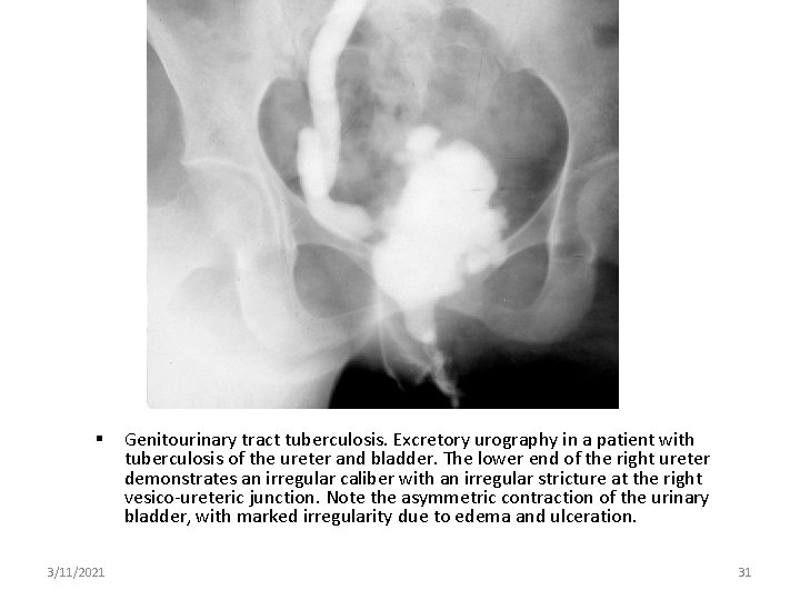  3/11/2021 Genitourinary tract tuberculosis. Excretory urography in a patient with tuberculosis of the