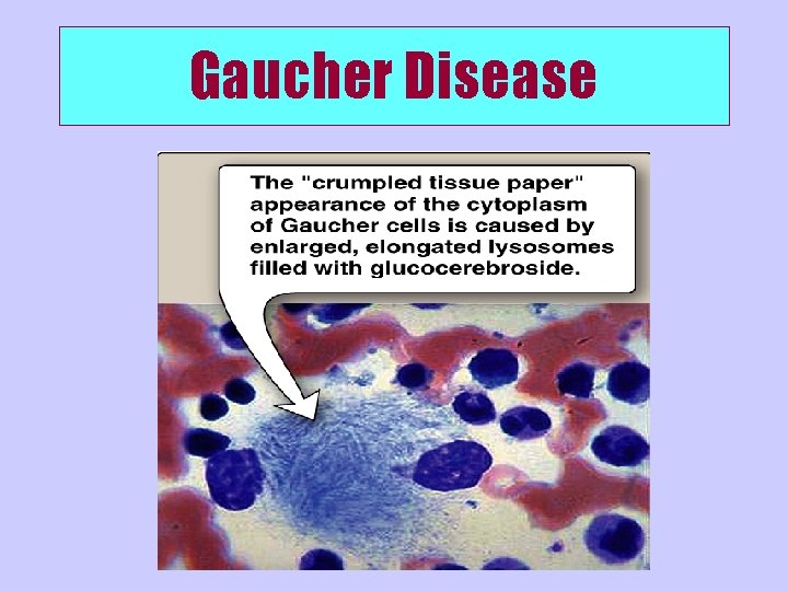 Gaucher Disease 