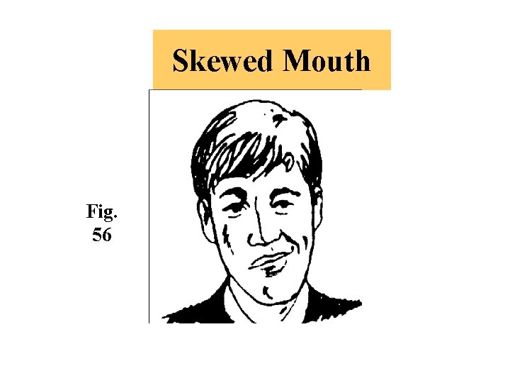 Skewed Mouth Fig. 56 