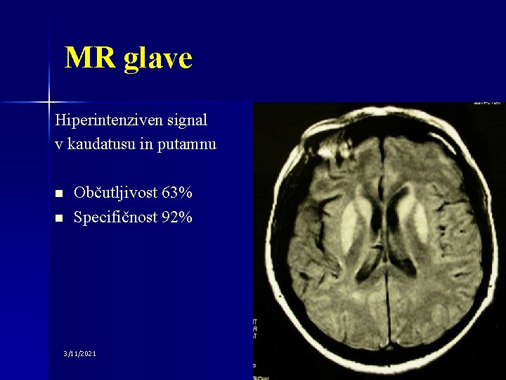 MR glave Hiperintenziven signal v kaudatusu in putamnu n n Občutljivost 63% Specifičnost 92%