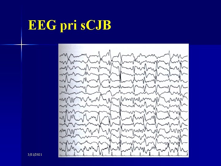 EEG pri s. CJB 3/11/2021 