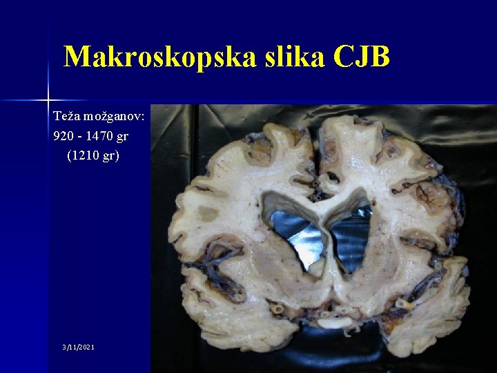 Makroskopska slika CJB Teža možganov: 920 - 1470 gr (1210 gr) 3/11/2021 