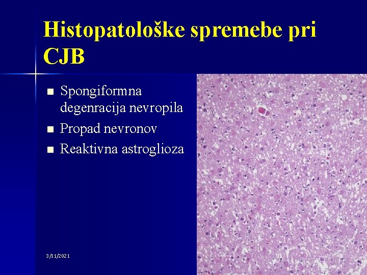 Histopatološke spremebe pri CJB n n n Spongiformna degenracija nevropila Propad nevronov Reaktivna astroglioza