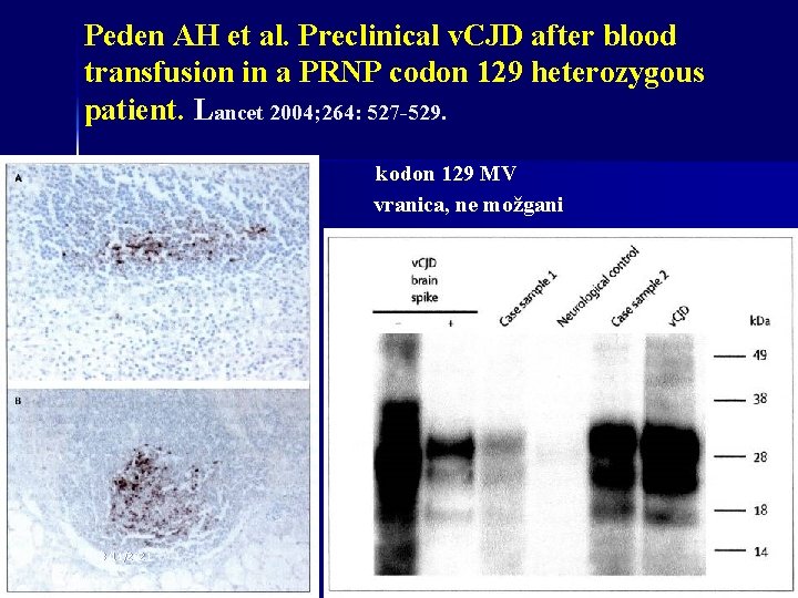 Peden AH et al. Preclinical v. CJD after blood transfusion in a PRNP codon