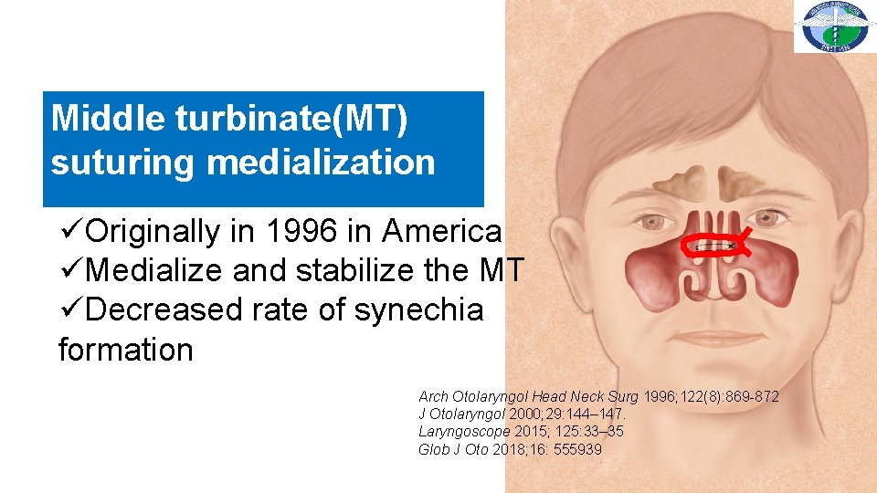 Middle turbinate(MT) suturing medialization üOriginally in 1996 in America üMedialize and stabilize the MT