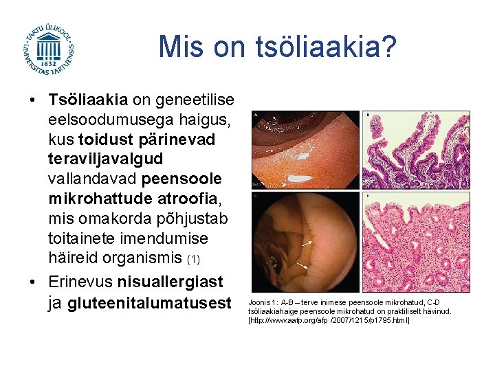 Mis on tsöliaakia? • Tsöliaakia on geneetilise eelsoodumusega haigus, kus toidust pärinevad teraviljavalgud vallandavad