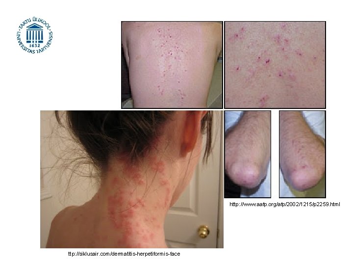 http: //www. aafp. org/afp/2002/1215/p 2259. html ttp: //siklusair. com/dermatitis-herpetiformis-face 