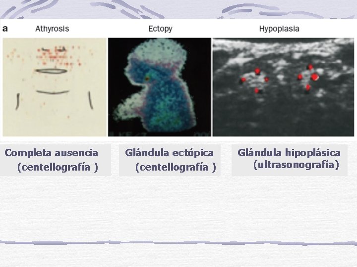Completa ausencia (centellografía ) Glándula ectópica (centellografía ) Glándula hipoplásica (ultrasonografía) 