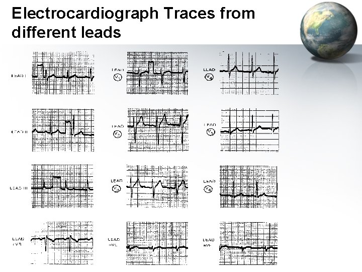 Electrocardiograph Traces from different leads 