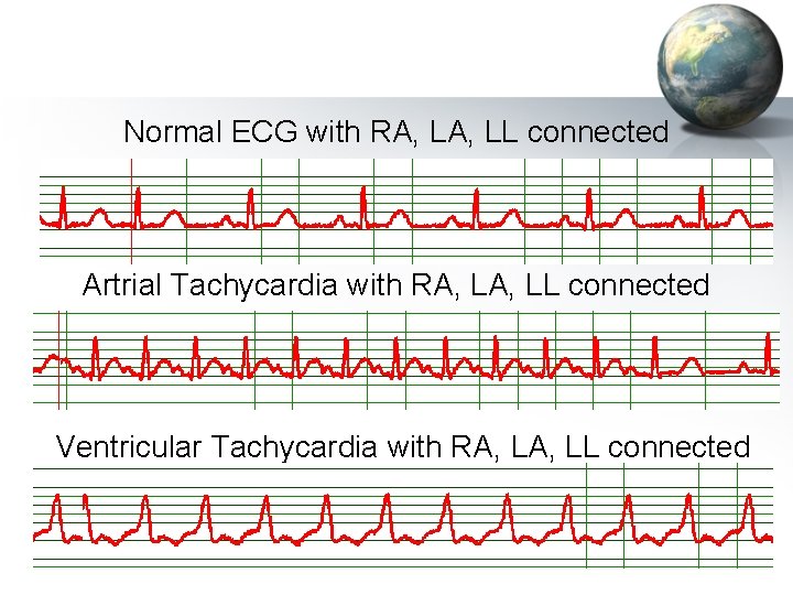 Normal ECG with RA, LL connected Artrial Tachycardia with RA, LL connected Ventricular Tachycardia