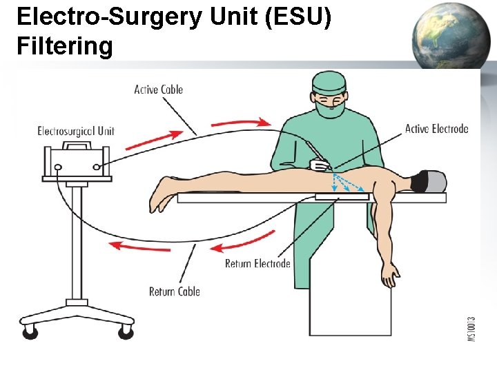 Electro-Surgery Unit (ESU) Filtering 