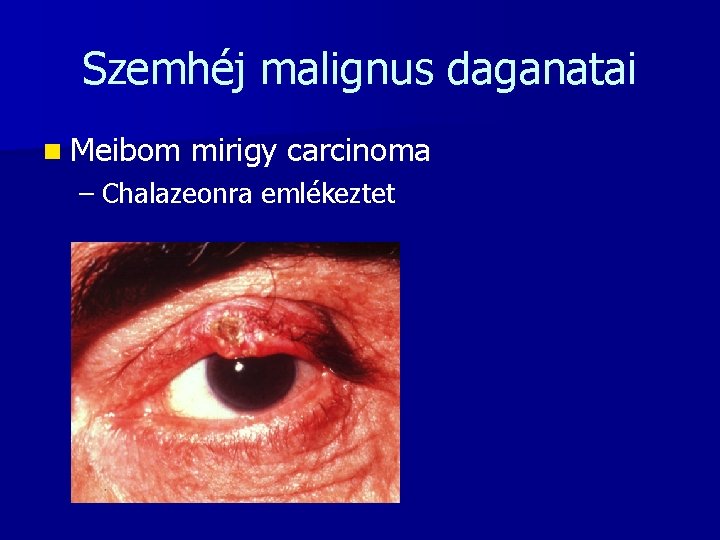 Szemhéj malignus daganatai n Meibom mirigy carcinoma – Chalazeonra emlékeztet 